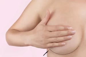 Mamoplastia Redutora