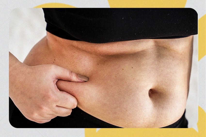 BodyTite no pós-parto: quando é seguro e quais resultados esperar